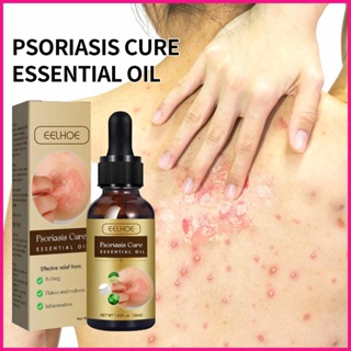 Psoriasis เอสเซ้นบํารุงผิวหน้า ให้ความชุ่มชื้น กําจัดสะเก็ดเงิน 30 มล. สําหรับทุกเพศ