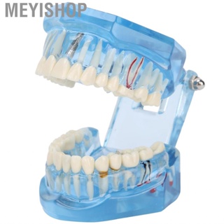 Meyishop Dentures Dental Model Acrylic Blue Transparent Teaching