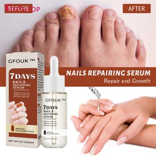 Cfouk 7 Days Nail Repair Essence ฟื้นฟูมือและเท้า Onychomycosis Rotten Toenail Soft Nail Thickening Moisturizing Care Essence [TOP]