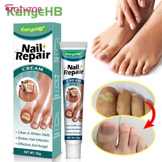 Kanyehb Grey Nail Toenail Cream เล็บมือ Toenail Cream Grey Nail Net [TOP]