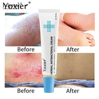 JULYSTAR 2023 Hot！20g Skin External Itching Yoxier Herbal Antibacterial Cream ครีมต้านเชื้อแบคทีเรียสะเก็ดเงิน