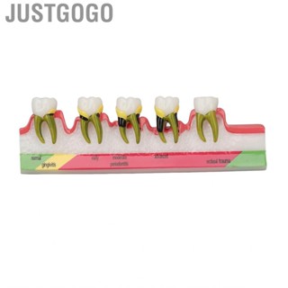 Justgogo Dental Periodontal Disease Model Resin  For Tooth Study