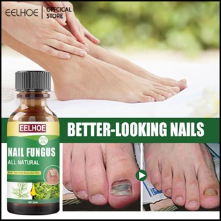 EELHOE 30ml toe nail tea tree oil เชื้อรา Care Solution Onychomycosis Antibacterial Foot Care Solution -eelhoe