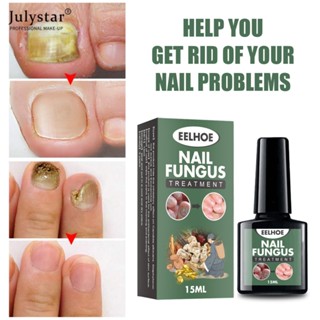 JULYSTAR Nail Fungus Treatment Essence ซ่อมแซมเล็บ Anti-fungal Nail Fungal Treatment Nail Care