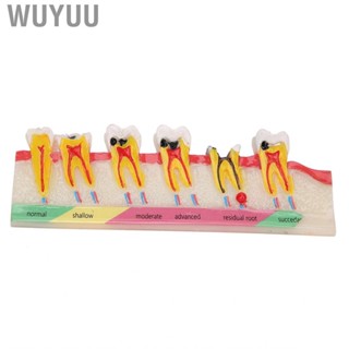 Wuyuu Dental Caries Developing Model Decayed  For Teaching Study