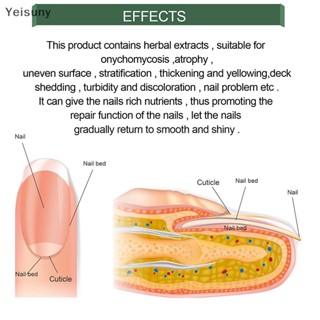 [Yei] เอสเซ้นบํารุงเล็บเท้า ป้องกันเชื้อราที่เล็บ 30 มล. COD