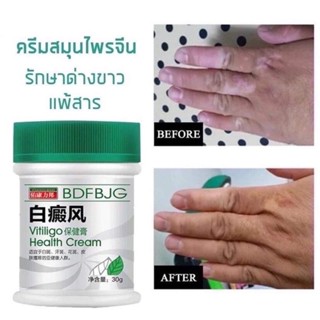 COD⚡ส่งภายใน24ชม⚡ Vitiligo Health Cream ครีมบำรุงผิว ผิวด่างขาวครีมสมุนไพรจีน รักษาโรคผิวหนัง จุดด่างดํา