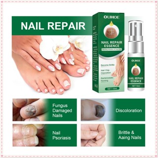 Ouhoe Nail Repair Essence Repair สีเหลืองสีเทาเล็บหนาเว้าและนูน Endophytic Nail Enhancer Anti-bacteria Serum Body Nail Care 10ml JOYFEEL