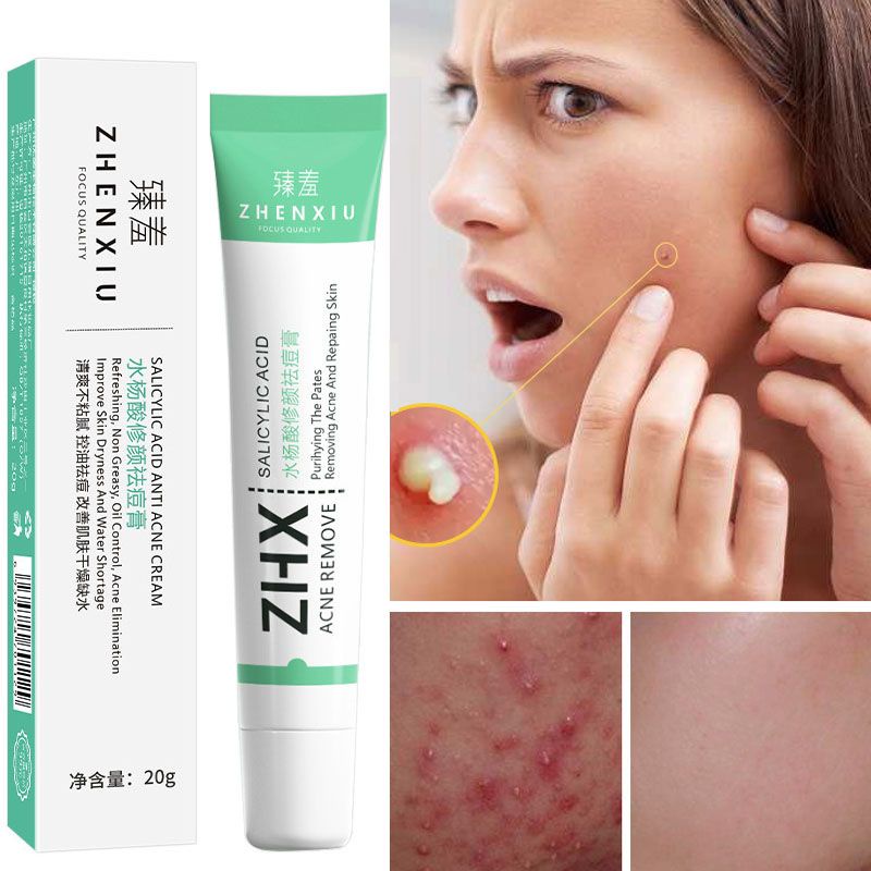 ZHENXIU Salicylic Acid Acne Remove Cream ปรับปรุงสิว Blackhead Oil Control ลบรอยสิว Skin Care