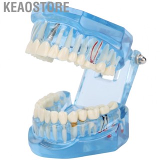 Keaostore Dentures Dental  Model Acrylic Blue Transparent Teaching