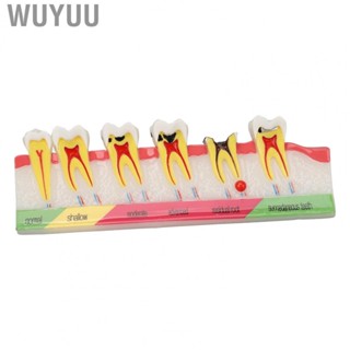 Wuyuu Dental Caries Developing Model Resin Dental Caries  Model Cross Section 6 Stages Clearly for Students for Dental Teaching