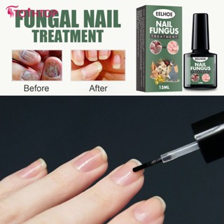 Eelhoe Nail Fungus Treatment Serum Feet Care Solution Soft Nail Care Toe Nail Fungal Removal Gel Anti Infection Foot Repair Liquid (15ml) [ด้านบน]