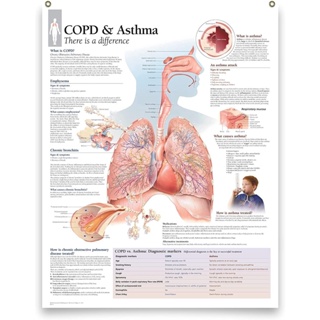 โปสเตอร์แผนภาพ รูปหมอ โรคหอบหืด ลามิเนต สําหรับห้องเรียน สํานักงาน