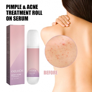 Pimple and Acne Treatment Roll On Serum Acne Clearing Butt Firming Tightening