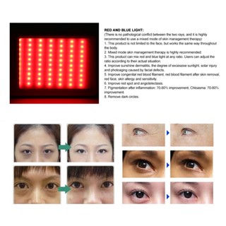 Mother &amp; Baby Photon Skin Rejuvenation Machine Red Blue Light Therapy อุปกรณ์ความงามกำจัดสิว