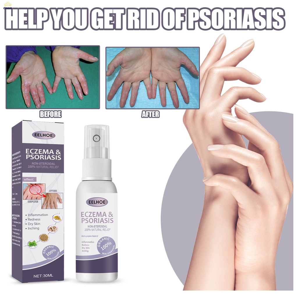 Eelhoe Tinea Pedis Spray ยาสมุนไพรจีน บรรเทาอาการคัน โรคผิวหนัง โรคสะเก็ดเงิน โรคเชื้อรา ยารักษาโรคเรื้อรัง พลาสเตอร์กลาก 【doom】