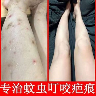 ขายดี#ครีมลบรอยแผลเป็นจากยุง รอยแผลเป็นจากยุง รอยแผลเป็นจากเมลานิน ฝนตก รอยดําบนขา ซ่อมแซมรอยแผลเป็นจากรอยขีดข่วน 5.17 Li
