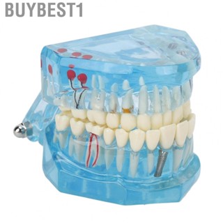 Buybest1 Dental Pathological Model Clear Teaching Detachable  Display B