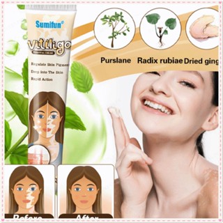 Sumifun Vitiligo Cream กำจัดขี้กลากจุดขาวที่มีการแปลเฉพาะที่ Leukoplakia Disease Treatment Antibacterial Ointment Body Care Product 1pc 20g JOYFEEL