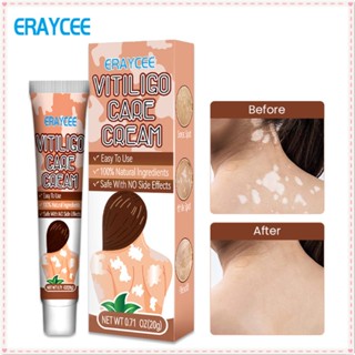 Eraycee Vitiligo Care ครีมกำจัดจุดขาวจุดเหงื่อปรับสีผิว Ointment บำรุงผิวส่วนผสมจากธรรมชาติ Treatment Body Care JOYFEEL