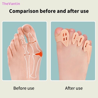 Thevantin 1 คู่ ซิลิโคนนิ้วเท้า แยกนิ้วเท้า ตาปลา Hallux Valgus แก้ไข นิ้วหัวแม่มือ แก้ไข ยืดนิ้วเท้า เครื่องมือดูแลเท้า สินค้าที่ดี