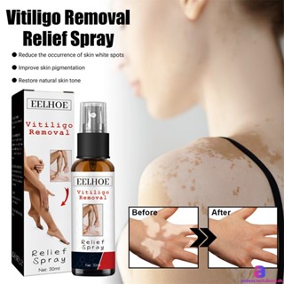 Eelhoe Vitiligo Removal Spray สเปรย์ซ่อมแซมจุดขาว Desalination Sweat Spot Moisturizing Skin Improve Skin Pigmentation Body Care 30ml AUBESSTECHSTORE AUBESSTECHSTORE