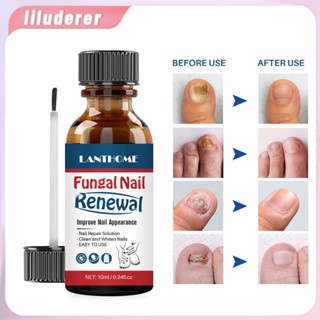 Fungal Nail Repair Essence Serum Toe Nail Fungus Treatment เล็บเจล Anti Infection Paronychia Onychomycosis เล็บ Care HO