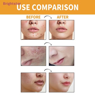 Brightstar แผ่นไฮโดรคอลลอยด์ มาสก์หน้าผาก สิว สิวเสี้ยน สําหรับจมูก คาง 10 ชิ้น ใหม่