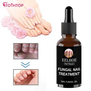 Eelhoe Nail Fungus Repair Treatment Essence 50ml Fungal Paronychia Treatment น้ำยาบำรุงเล็บ [TOP]