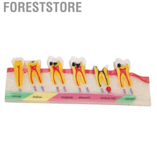 Foreststore Dental Caries Developing Model Decayed  For Teaching Study