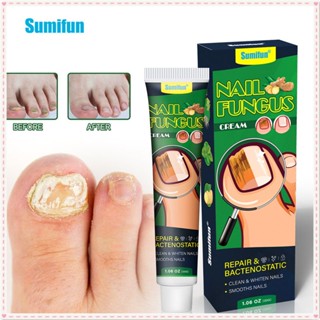 Sumifun Nail Fungus Cream Repair Onychomycosis Reduce Nail Fungal Infection Anti-bacteria Nourishing Toenail Ointment Body Foot Care JOYFEEL