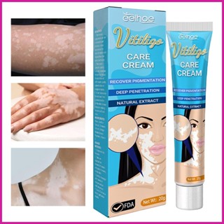 Vitiligo ครีมบํารุงผิว 20 กรัม บรรเทาจุดด่างดําบนผิว และกําจัดเซลล์ผิวที่ตายแล้ว ใช้ง่าย