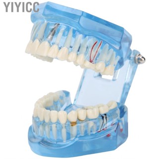 Yiyicc Dentures Dental Model Acrylic Blue Transparent Teaching