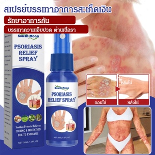 Psoriasis สเปรย์ดูแลผิว ป้องกันอาการคัน