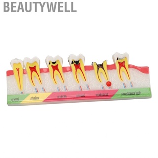 Beautywell Caries Development Model 6 Stages  For Dental Clinic