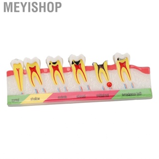 Meyishop Caries Development Model 6 Stages  For Dental Clinic