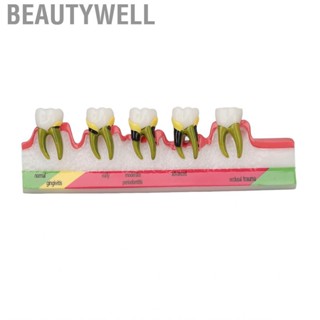 Beautywell Dental Periodontal Disease Model Resin  For Tooth Study