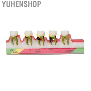 Yuhenshop Dental Periodontal Disease Model Resin  For Tooth Study