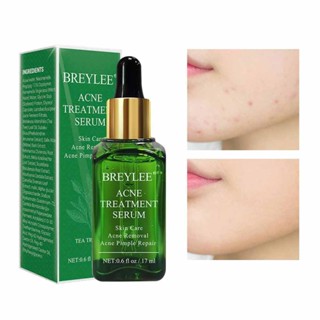 BREYLEE Acne Control Serum Scar Cure Cream Whitening Repair Pimple 17ml