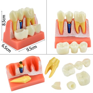 โมเดลมงกุฎวิเคราะห์ฟัน แบบถอดออกได้ สําหรับทันตกรรม
