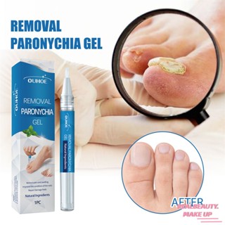 OUHOE Onychomycosis Repair Gel ซ่อมแซมได้อย่างมีประสิทธิภาพเสริมสร้างและฟื้นฟูเล็บ Toe Fungus Treatment Body Care ปรับปรุงรูปลักษณ์ที่มีประสิทธิภาพ Repair Toe Fungus Repair Gel [realbeauty]