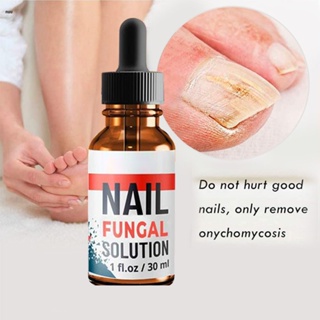 30ml เท้า Anti-fungal Essence ลบ Onychomycosis Repair Treatment Liquid Healthy Nail Care Repair Liquid nuuo