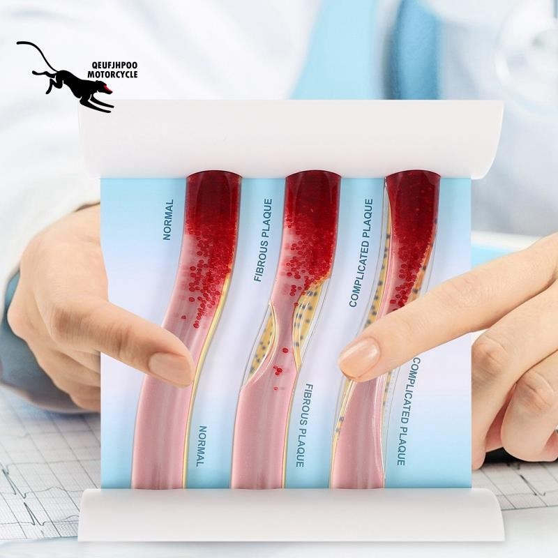 ซูเปอร์ไดนามิกเลือดเรือรุ่นโรคหลอดเลือดสมองบล็อกเสียงคมชัดรุ่นทรอมโบซิสรุ่นสําหรับการเรียนการสอนคําอธิบาย