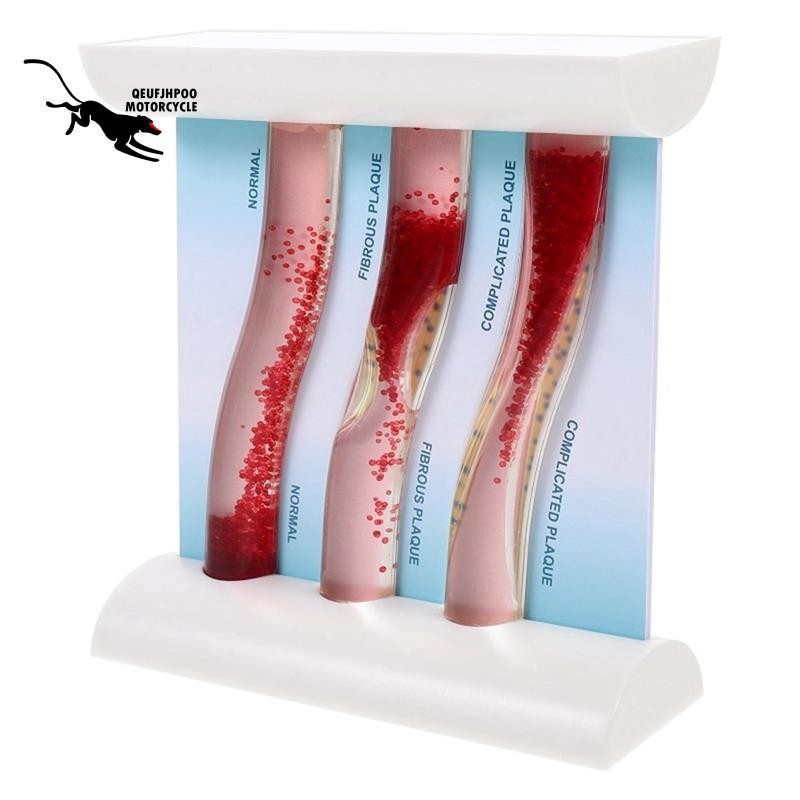 ซูเปอร์ไดนามิกเลือดเรือรุ่นโรคหลอดเลือดสมองบล็อกเสียงคมชัดรุ่นทรอมโบซิสรุ่นสําหรับการเรียนการสอนคําอธิบาย