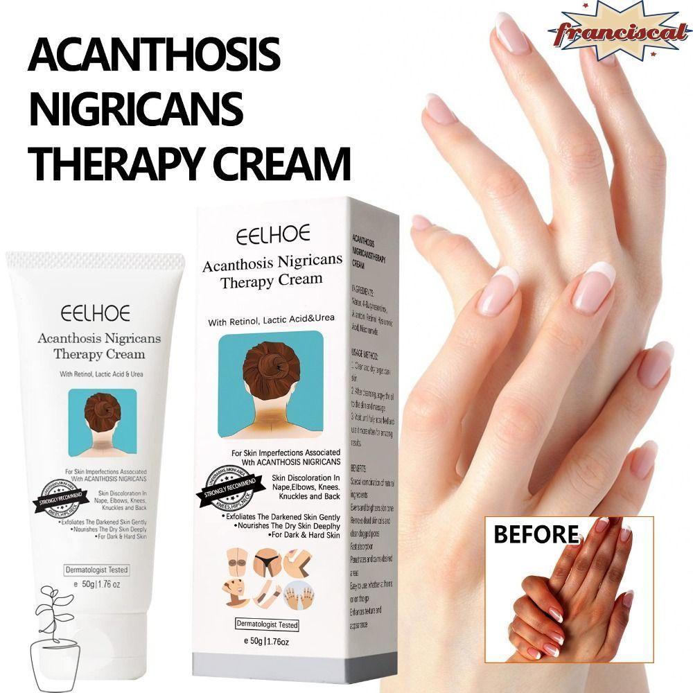 Franciscal Nigricans Therapy Cream Moist Dark Spot Remover Nigrifree Acanthosis Body Care Cream Dark Spot Corrector Cream