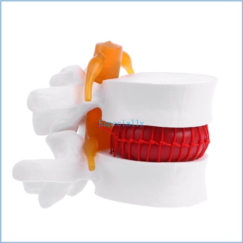 Esp Human Anatomical Lumbar Disc Herniation Model เรียนรู้ทางการแพทย์ Aid Anatomy Instrume