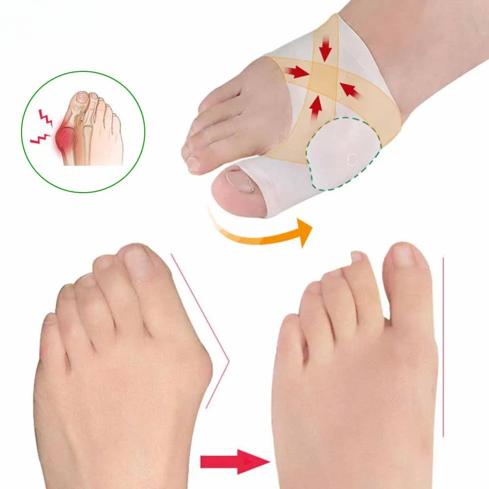 1 คู่ใหม่เจลศัลยกรรมกระดูก Bunion Corrector แขน - Foot Bunion Protector- Hallux Valgus Big Toe Bunio