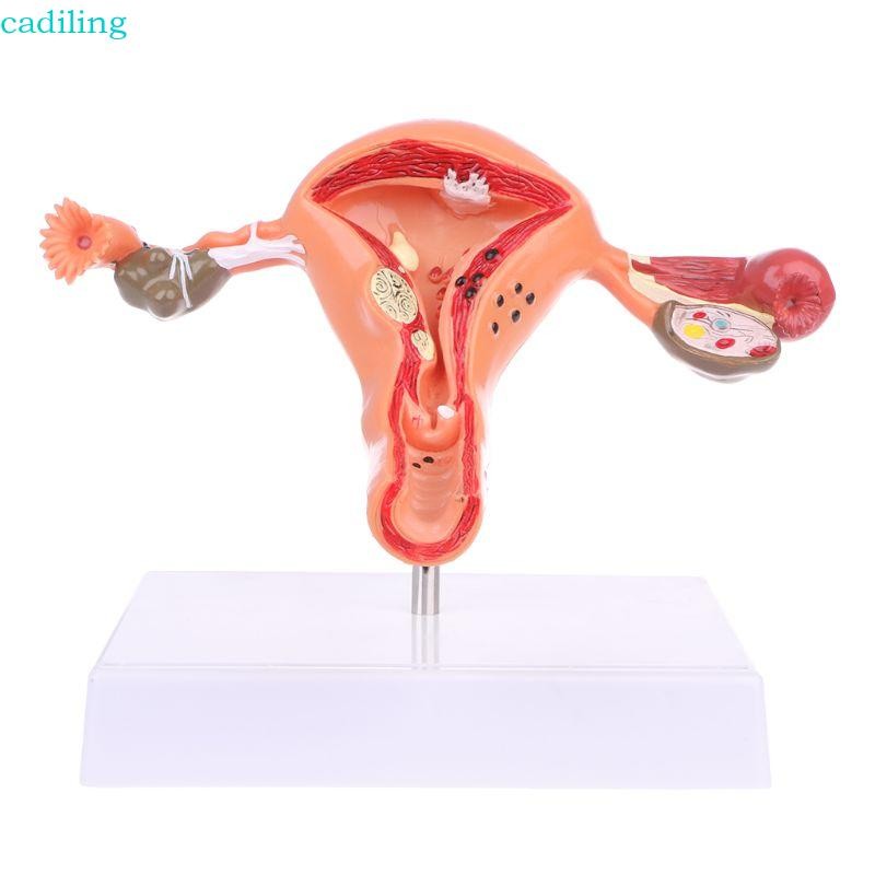 Cadiling มดลูกทางพยาธิวิทยา Ovary Anatomical Model Anatomical สําหรับเครื่องมือศึกษาส่วนข้าม