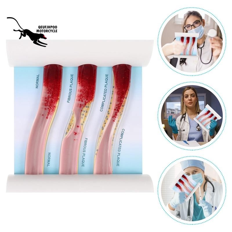 ซูเปอร์ไดนามิกเลือดเรือรุ่นโรคหลอดเลือดสมองบล็อกเสียงคมชัดรุ่นทรอมโบซิสรุ่นสําหรับการเรียนการสอนคําอธิบาย