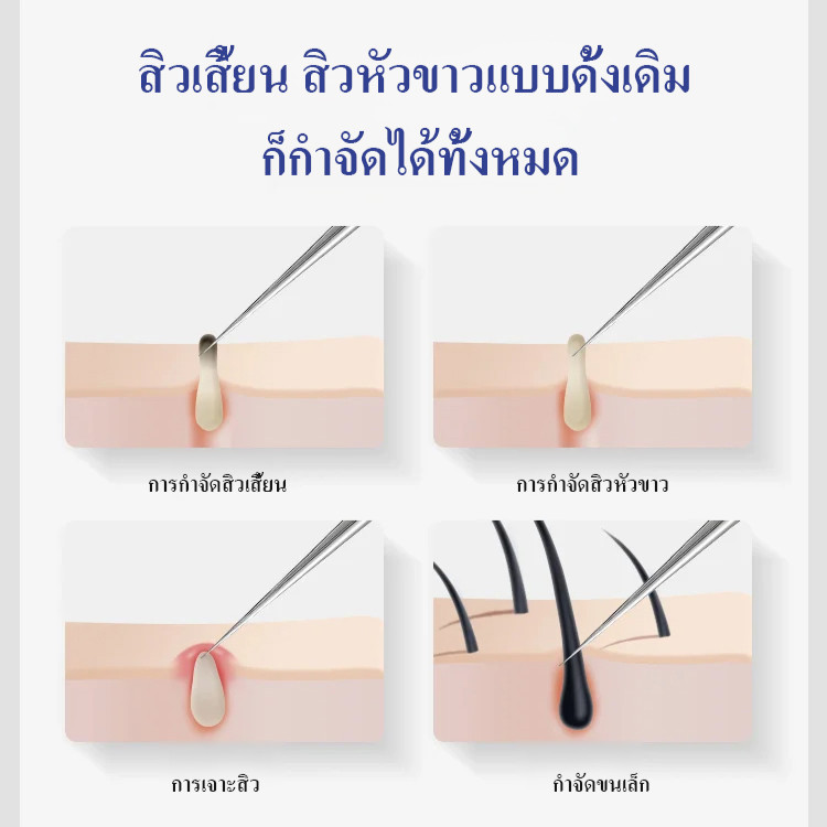 💦อัพเกรดไ💦เข็มกําจัดสิว ปริมาณตะกั่วต่ํา มีแนวโน้มที่จะติดเชื้อ ปราศจากความเจ็บปวดและต้านเชื้อแบคทีเรีย การฟื้นตัวของบาดแผลอย่างรวดเร็ว เข็มเจาะสิว กดสิว เข็มสิวแบบใช้แล้วทิ้ง เข็มปิดปาก เม็ดไขมัน กําจัดสิวหัวดํา - รูปที่ 7
